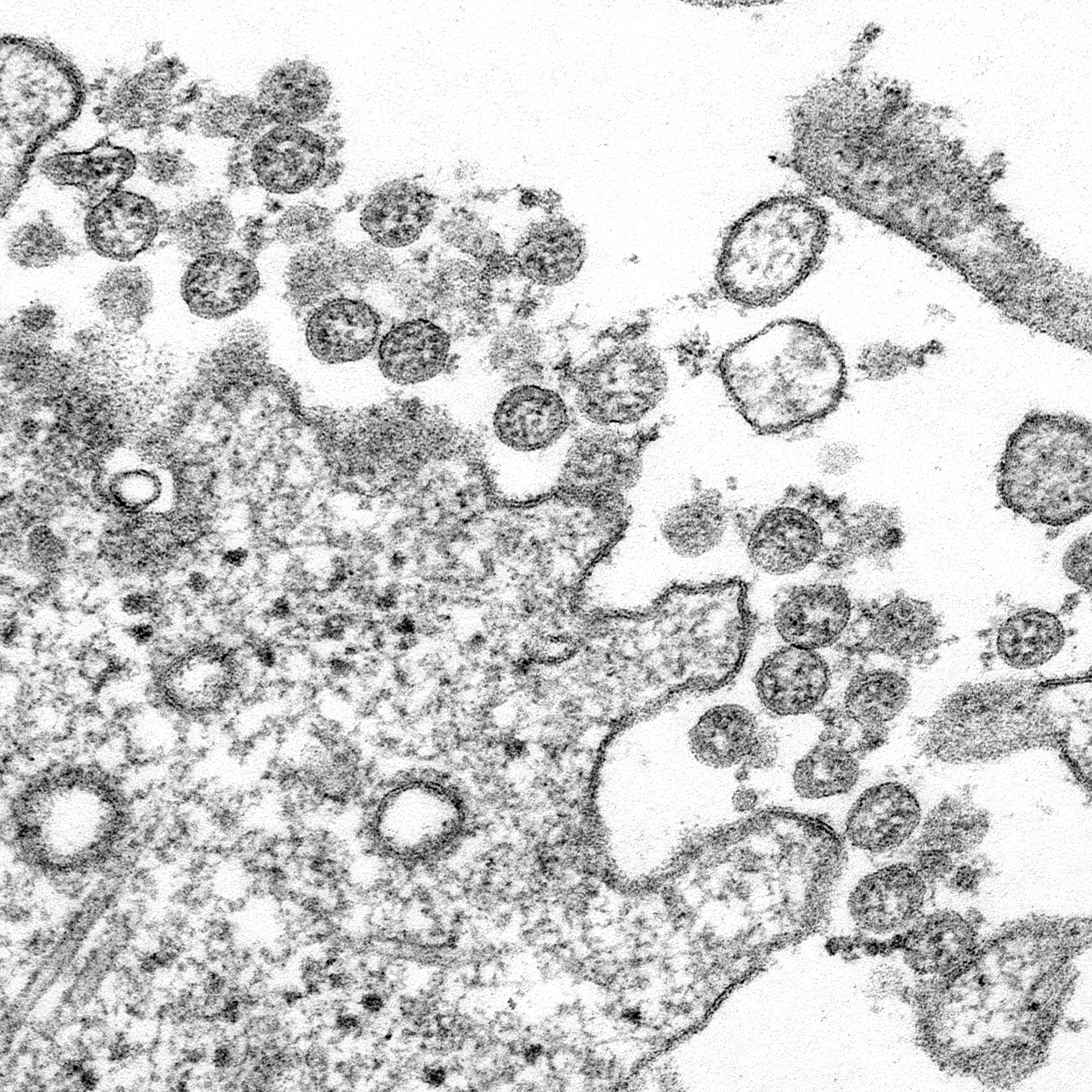 COVID-10 Pandemic. Transmission electron microscopic image of an isolate from the first U.S. case of COVID-19